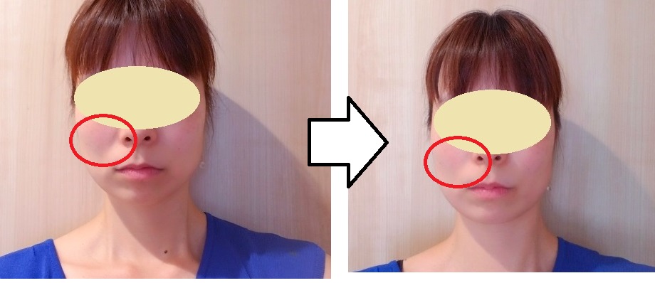 【体験談】ightフェイスブラは本当に効果があるの？口コミも調査！