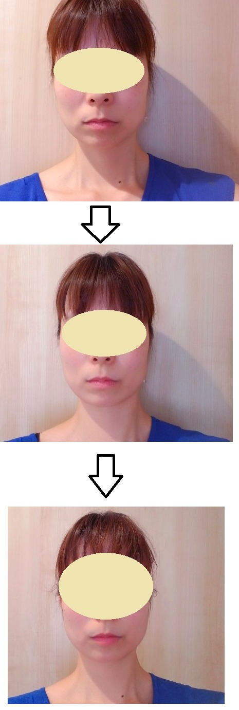 【体験談】ightフェイスブラは本当に効果があるの？口コミも調査！